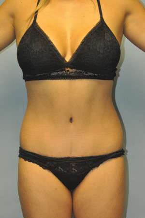 Abdominoplasty Case 4998 After Photo Abdominoplasty