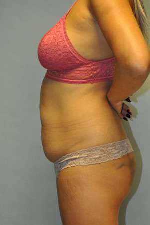 Abdominoplasty Case 4998 Before Photo Abdominoplasty