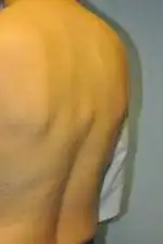 Minimal Incision and Power-assisted Liposuction Removal of Lipomas