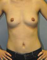 Breast Augmentation, Gel