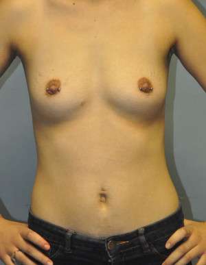 Breast Augmentation, Gel Case 5016 Before Photo Breast Augmentation, Gel