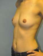 Breast Augmentation, Gel