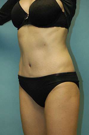 Abdominoplasty Case 5187 After Photo Abdominoplasty