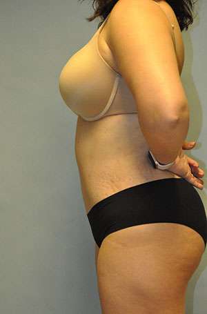 Abdominoplasty Case 5199 After Photo Abdominoplasty