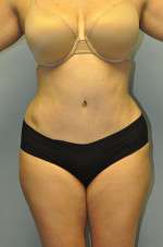 Abdominoplasty