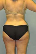 Abdominoplasty
