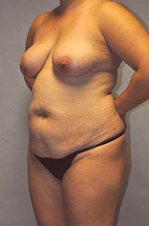 Abdominoplasty Case 5199 Before Photo Abdominoplasty