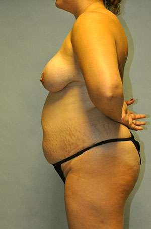 Abdominoplasty Case 5199 Before Photo Abdominoplasty