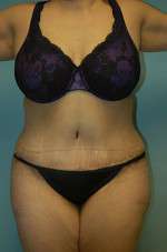 Abdominoplasty