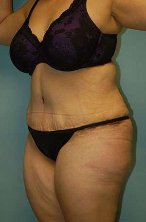 Abdominoplasty Case 5209 After Photo Abdominoplasty