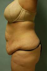 Abdominoplasty
