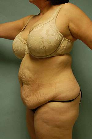 Abdominoplasty Case 5209 Before Photo Abdominoplasty