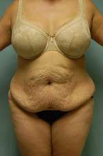 Abdominoplasty