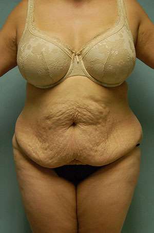 Abdominoplasty Case 5209 Before Photo Abdominoplasty
