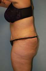 Abdominoplasty
