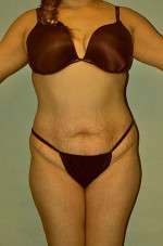 Brazilian Buttocks Lift