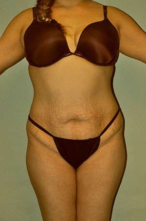 Brazilian Buttocks Lift Case 5217 Before Photo Brazilian Buttocks Lift