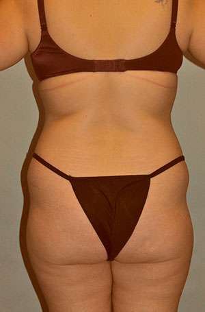 Brazilian Buttocks Lift Case 5217 After Photo Brazilian Buttocks Lift