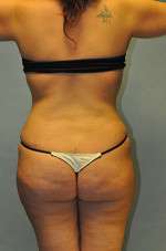 Brazilian Buttocks Lift