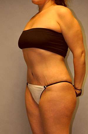 Brazilian Buttocks Lift Case 5217 After Photo Brazilian Buttocks Lift
