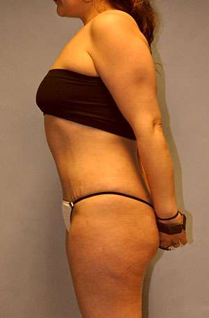 Brazilian Buttocks Lift Case 5217 After Photo Brazilian Buttocks Lift