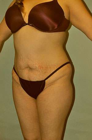Brazilian Buttocks Lift Case 5217 Before Photo Brazilian Buttocks Lift