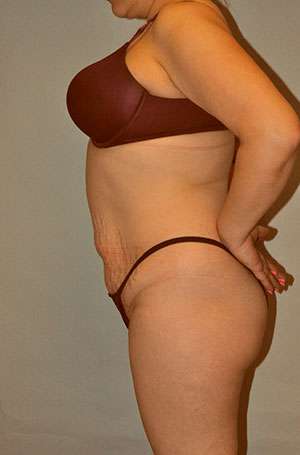 Brazilian Buttocks Lift Case 5217 Before Photo Brazilian Buttocks Lift