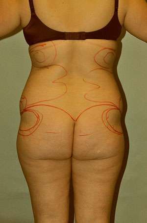 Brazilian Buttocks Lift Case 5217 Before Photo Brazilian Buttocks Lift
