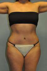 Brazilian Buttocks Lift