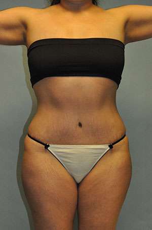Brazilian Buttocks Lift Case 5217 After Photo Brazilian Buttocks Lift