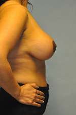 Mastopexy