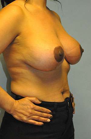Mastopexy