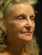 SmartSkin Wrinkle Removal-Fractional CO2
