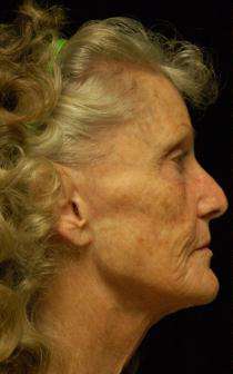 SmartSkin Wrinkle Removal-Fractional CO2