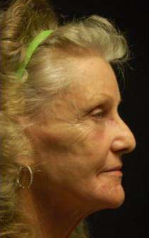SmartSkin Wrinkle Removal-Fractional CO2