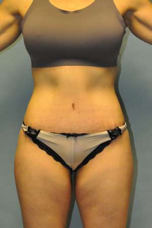 Abdominoplasty