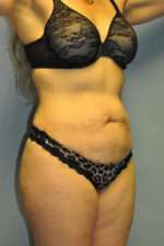 Abdominoplasty