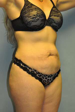 Abdominoplasty