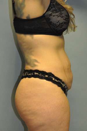 Abdominoplasty