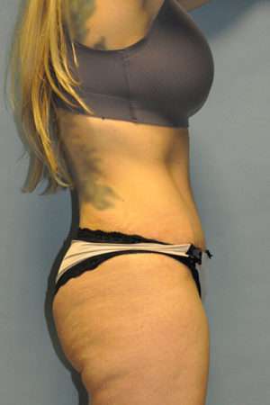 Abdominoplasty