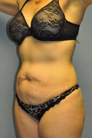 Abdominoplasty