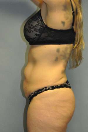 Abdominoplasty