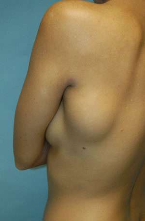 Minimal Incision and Power-assisted Liposuction Removal of Lipomas Case 5342 Before Photo Minimal Incision and Power-assisted Liposuction Removal of Lipomas