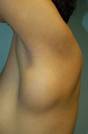Minimal Incision and Power-assisted Liposuction Removal of Lipomas Case 5342 Before Photo Minimal Incision and Power-assisted Liposuction Removal of Lipomas