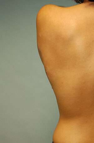 Minimal Incision and Power-assisted Liposuction Removal of Lipomas Case 5342 After Photo Minimal Incision and Power-assisted Liposuction Removal of Lipomas