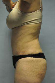 Abdominoplasty Case 5379 After Photo Abdominoplasty