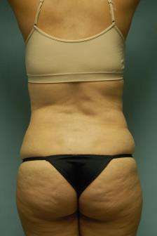 Abdominoplasty Case 5379 Before Photo Abdominoplasty