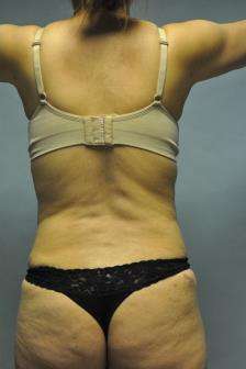 Abdominoplasty Case 5379 After Photo Abdominoplasty