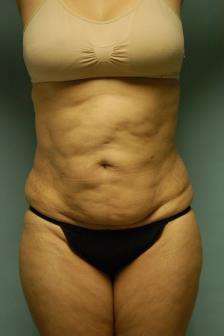 Abdominoplasty Case 5379 Before Photo Abdominoplasty