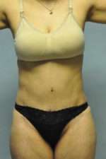 Abdominoplasty